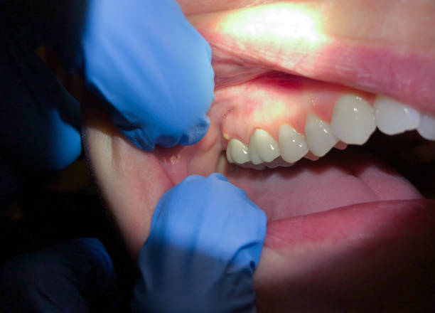 Best Urgent Care for Lost Fillings or Crowns in Bellevue, WA