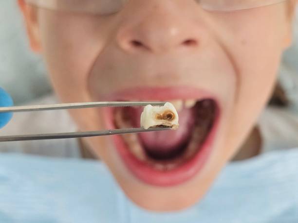 Best Emergency Treatment for Dental Infections or Abscesses in Bellevue, WA
